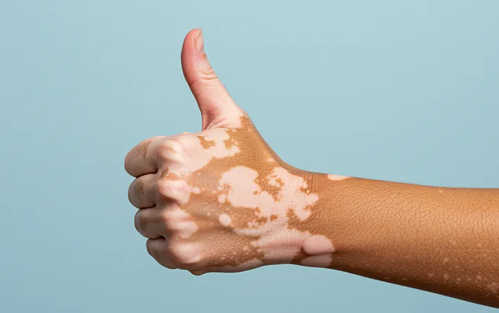 Eine Hand mit Pikmentstörungen der Haut zeigt den Daumen nach oben