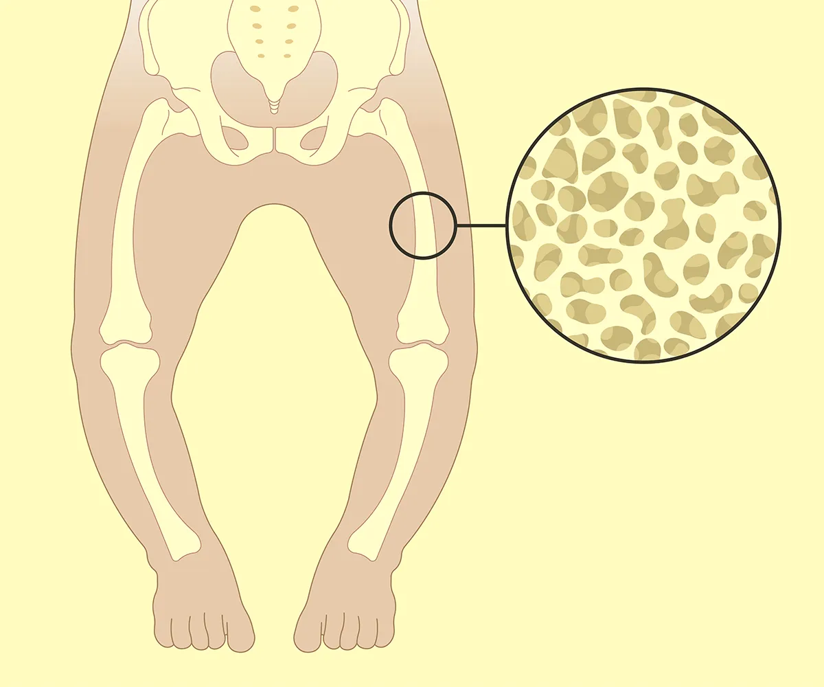 Schemadarstellung von Beinen eines kleinen Kindes mit einer Vergrößerung auf den Oberschenkelknochen und eine luftige Struktur des Knochen
