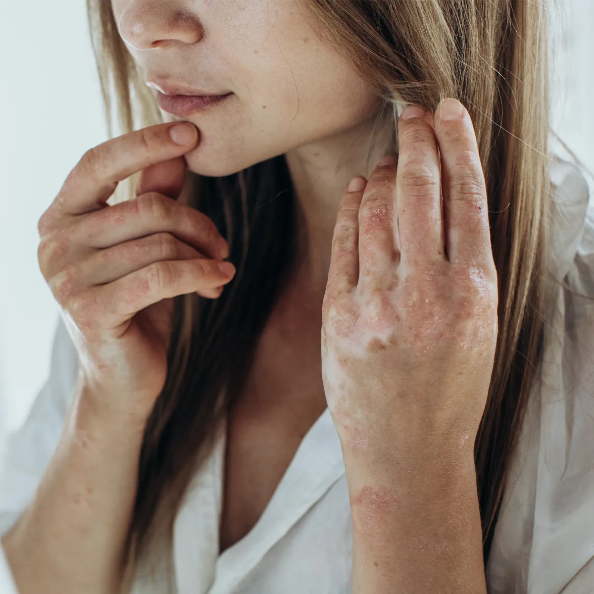 Symptome Auswirkungen von Autoimmunerkrankungen Eine weibliche Person mit trockenen, teils offenen Stellen an Handgelenken und -rücken